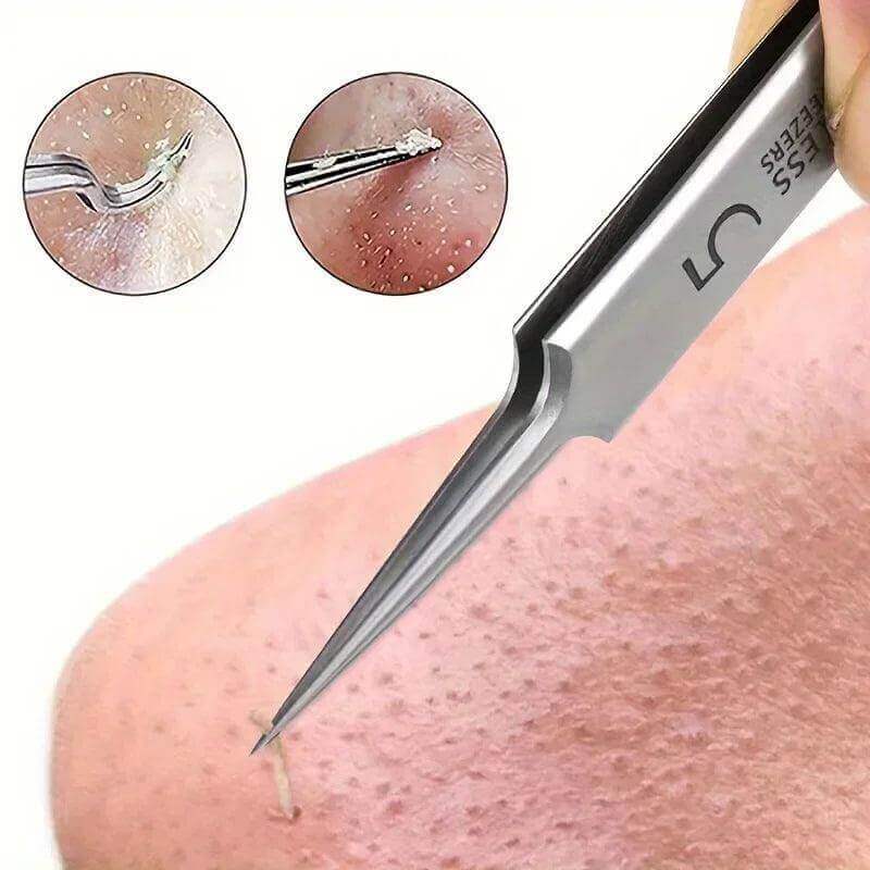 Blackhead Tweezers - Acne Needle & Facial Removal Tool - Viva Bella