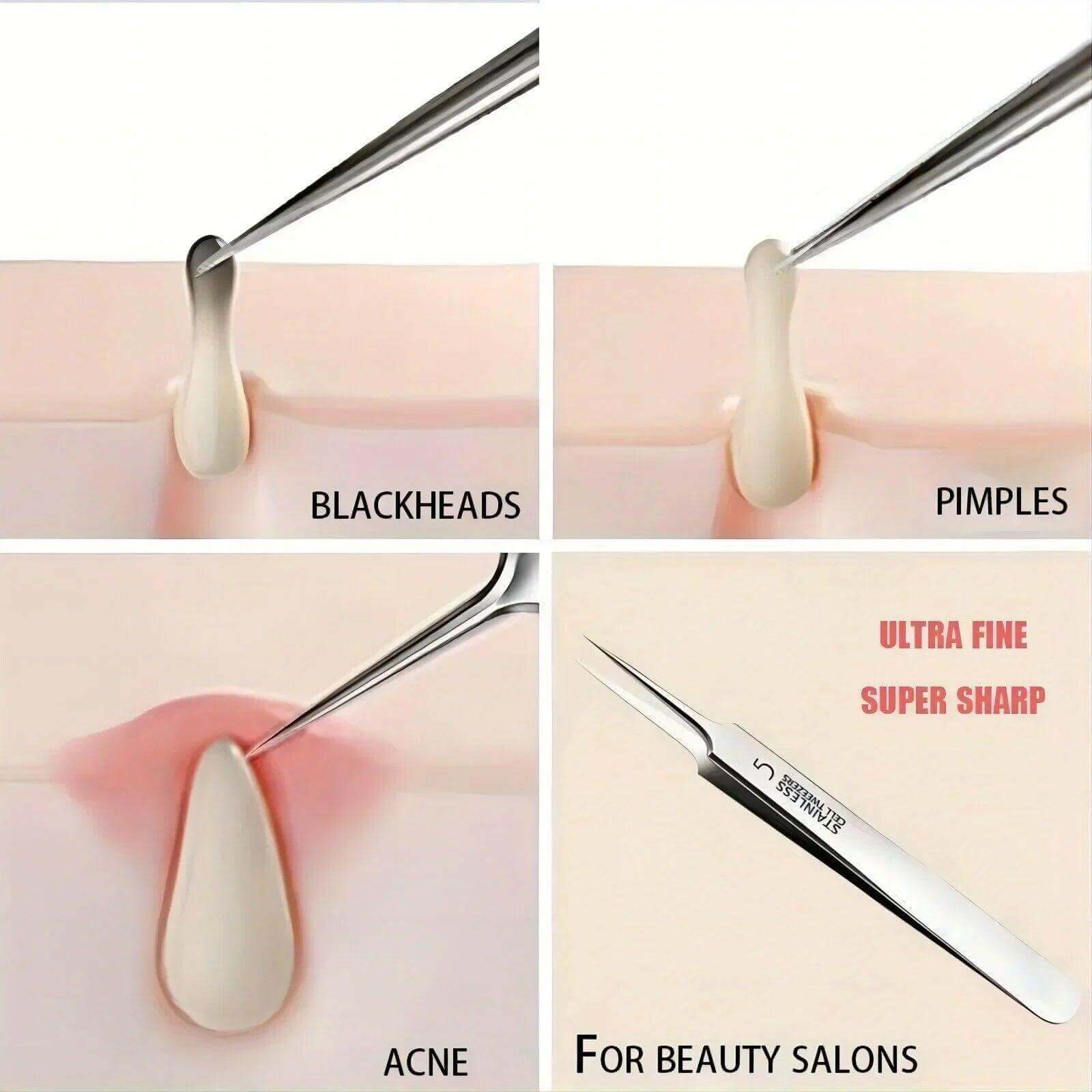 Blackhead Tweezers - Acne Needle & Facial Removal Tool - Viva Bella